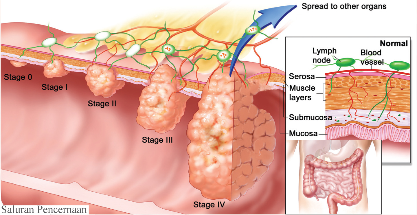 Рак 4 стадии вылечивается. Опухолитолсктой кишки. Опухоль Толстого кишечника.